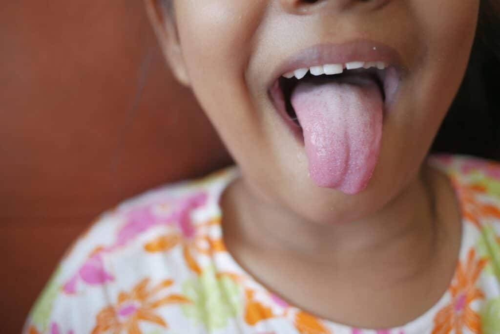 Tongue Tie and Lip Tie